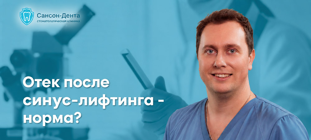 Отек после синус-лифтинга: сколько держится, что считается нормой и когда обращаться к врачу?